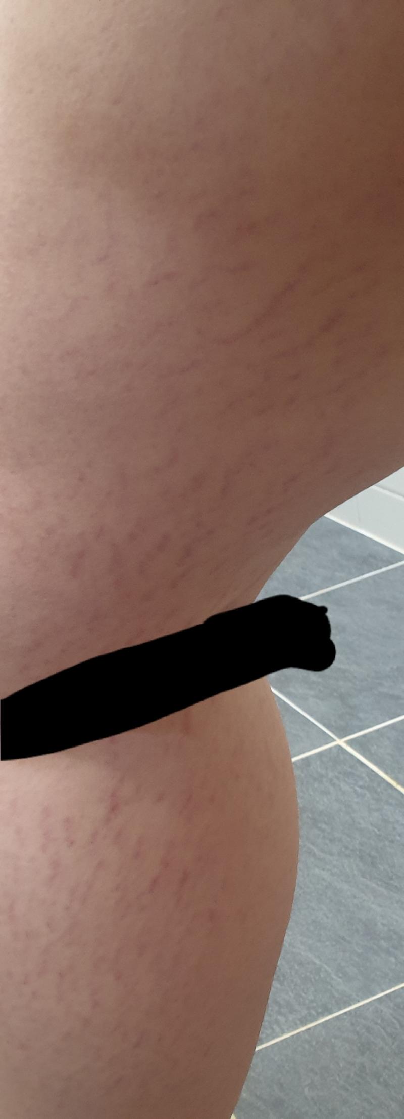 >>2 셀룰라이트인가..? 갈색이나 하얀색은 아니구 이랭... 어 사진 좀 징그럴수도 이쓰... 튼살이라치면 똑같이 사진 나와서ㅠㅠㅠ튼살아닝가ㅠ
