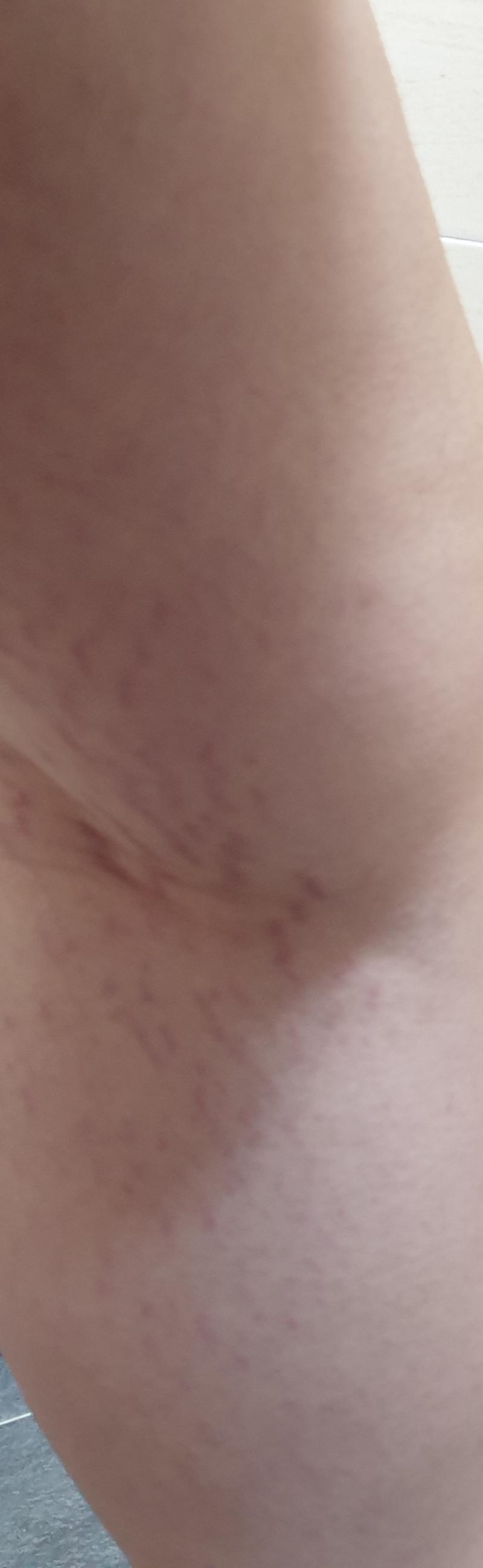 >>2 셀룰라이트인가..? 갈색이나 하얀색은 아니구 이랭... 어 사진 좀 징그럴수도 이쓰... 튼살이라치면 똑같이 사진 나와서ㅠㅠㅠ튼살아닝가ㅠ