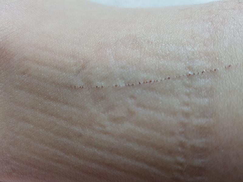 가끔 몸에 이런 상처 생기는데 다쳤다기도 애매하면서 신경쓰이는 거 짜증나