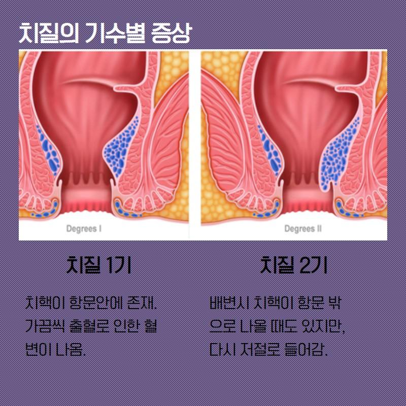 치질 3기 아님..?