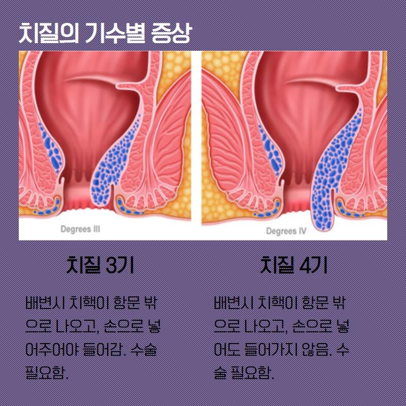 치질 3기 아님..?