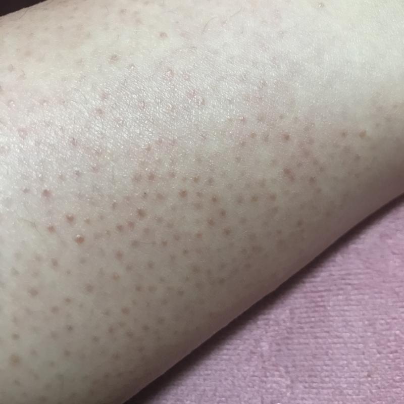 종아리다 ㅠㅠ 팔에도 있어 내 콤플렉스