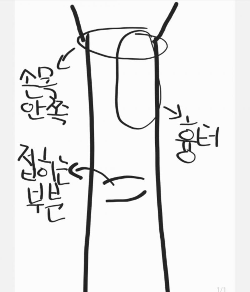 대충 그림으로 그려봤는데 실제로 보면 티가 좀 많이 나고 흉터가 튀어나와서 컨실러로 가려도 답이 없어...팔 전체로 따졌을 때 4분의 1을 흉터