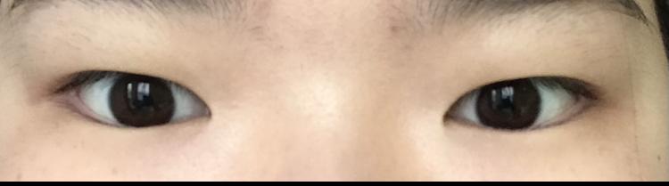 >>8 일단 쌍수 전부터 보여줄게 1은 쌍테 (난 ㄹㅇ 쌍테랑 한 몸이었음) 2는 걍 평소 눈 3은 쌍테 안 붙이고 붓기 좀 빠졌을때