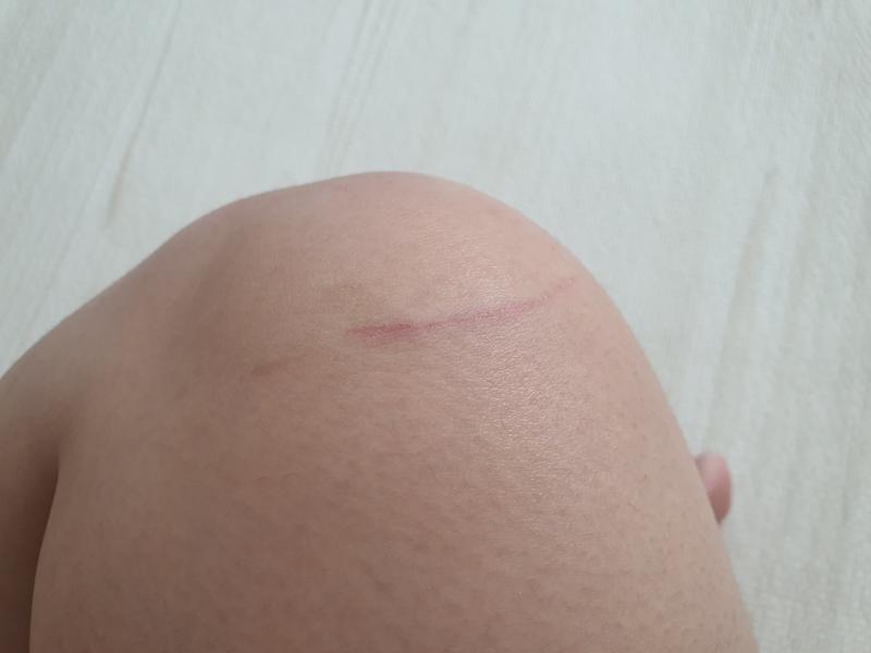 일부러 낸 상처 1도 없고 다 문득 따가워서 보니까 생겨있던 상처야ㅜ