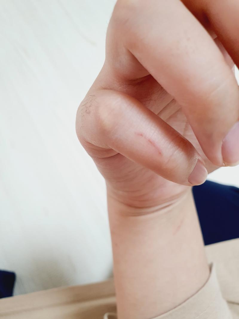 일부러 낸 상처 1도 없고 다 문득 따가워서 보니까 생겨있던 상처야ㅜ