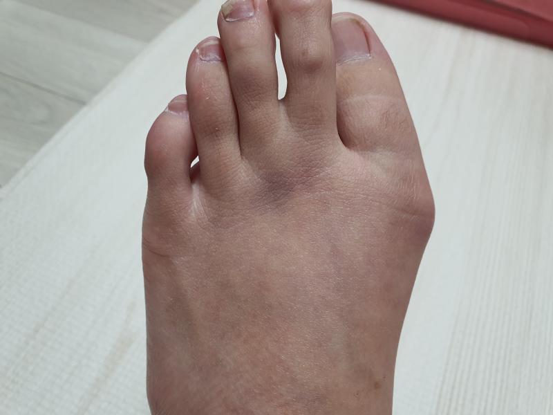 이건 좀 혐짤일수도; 두번째사진은 검지랑 중지 아래쪽에 멍든건데 사진으론 잘 안보이네;; 이건 아프지도 않다가 멍든거 보고서야 안것들...