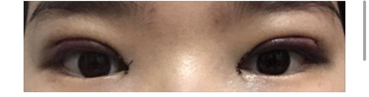 >>18 수술 다음날 저녁 D+3 저녁 일주일 후 실밥 푼 날 수술 당일에만 붓기가 심했고 저때도 많이 부어있긴 한데 다른 사람들 사례 보니까