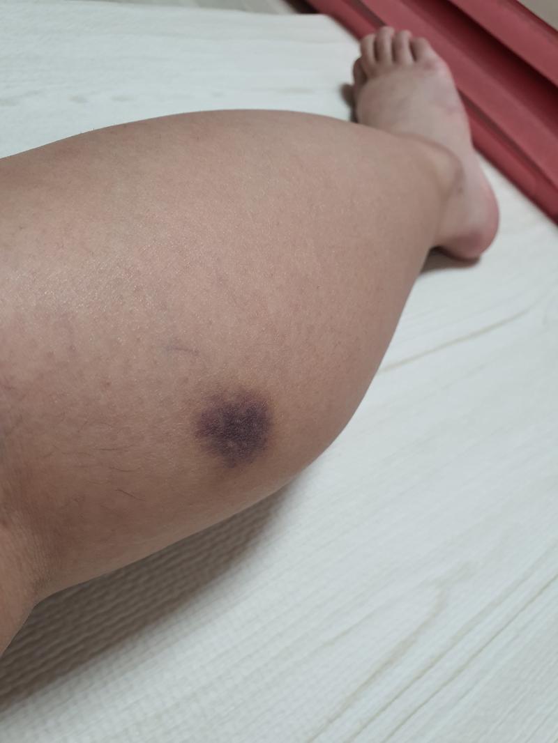 이건 좀 혐짤일수도; 두번째사진은 검지랑 중지 아래쪽에 멍든건데 사진으론 잘 안보이네;; 이건 아프지도 않다가 멍든거 보고서야 안것들...