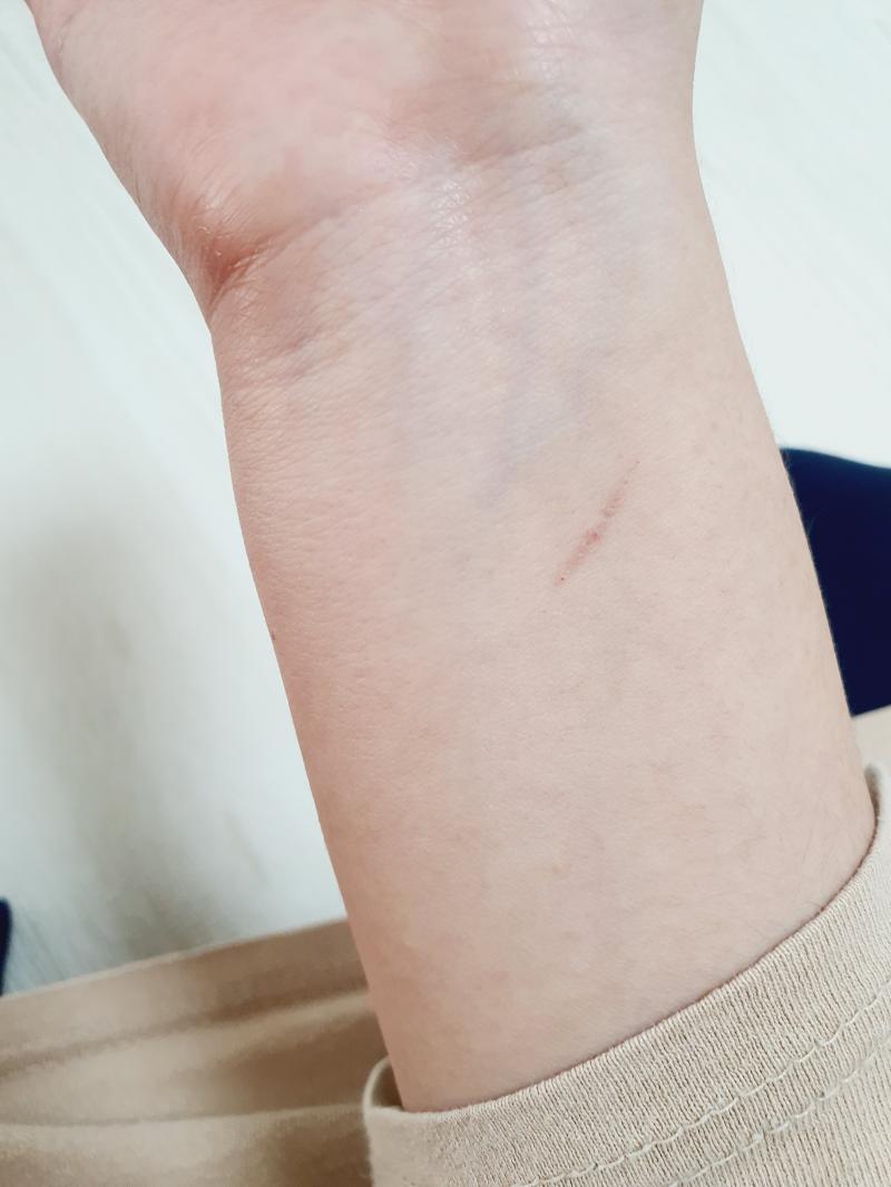 일부러 낸 상처 1도 없고 다 문득 따가워서 보니까 생겨있던 상처야ㅜ