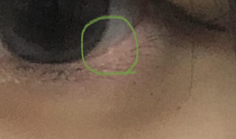 눈에 뭐 생겼는데 이거 뭐야?? 엄마가 황관종? 이라고 했는데 검색해도 제대로된 내용이 안 나와서,,