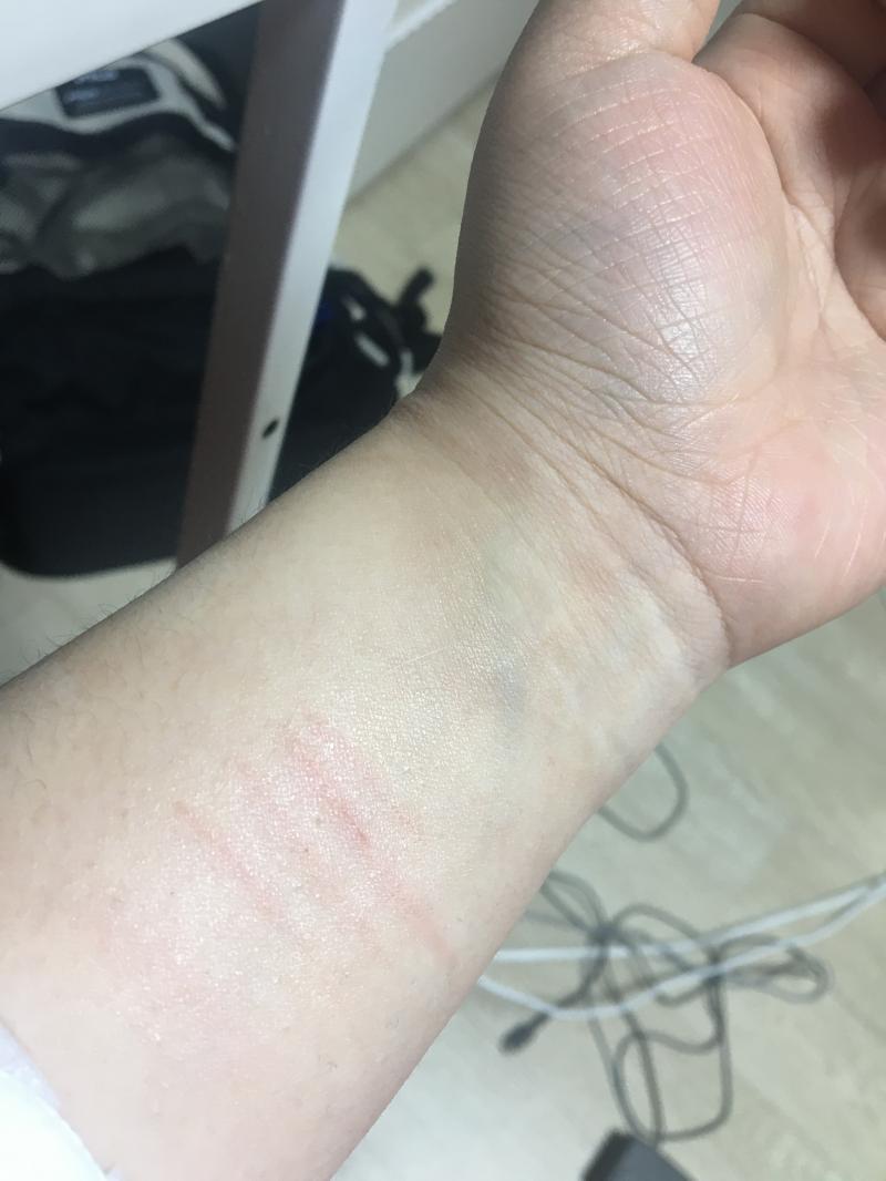 오늘 낮에 하고 정신없어서 냅두다가 갑자기 생각나서 방금 상처연고 바르긴 했어