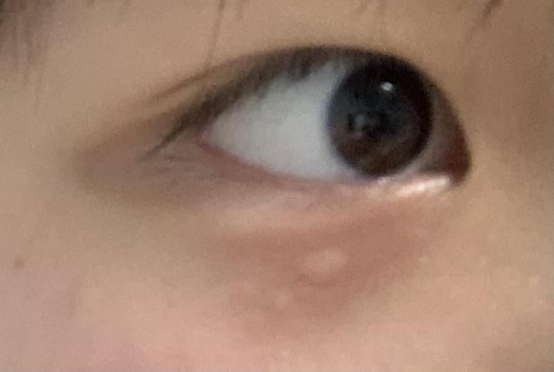 얘들아 원래 눈 다래끼가 이렇게 눈 아랫쪽에도 나? ㅠㅠㅠㅠㅠㅠㅠㅠㅠㅠ 분명 몇 분 전까지만 해도 눈 위에 애굣살처럼 얇게 있었는데 갑자기 그