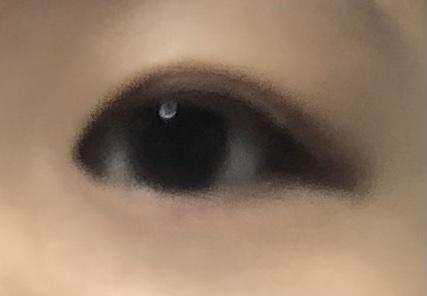 다른 한쪽도 쌍커플 있는데 얇은 속쌍이어서 짝짝이 처럼 보임