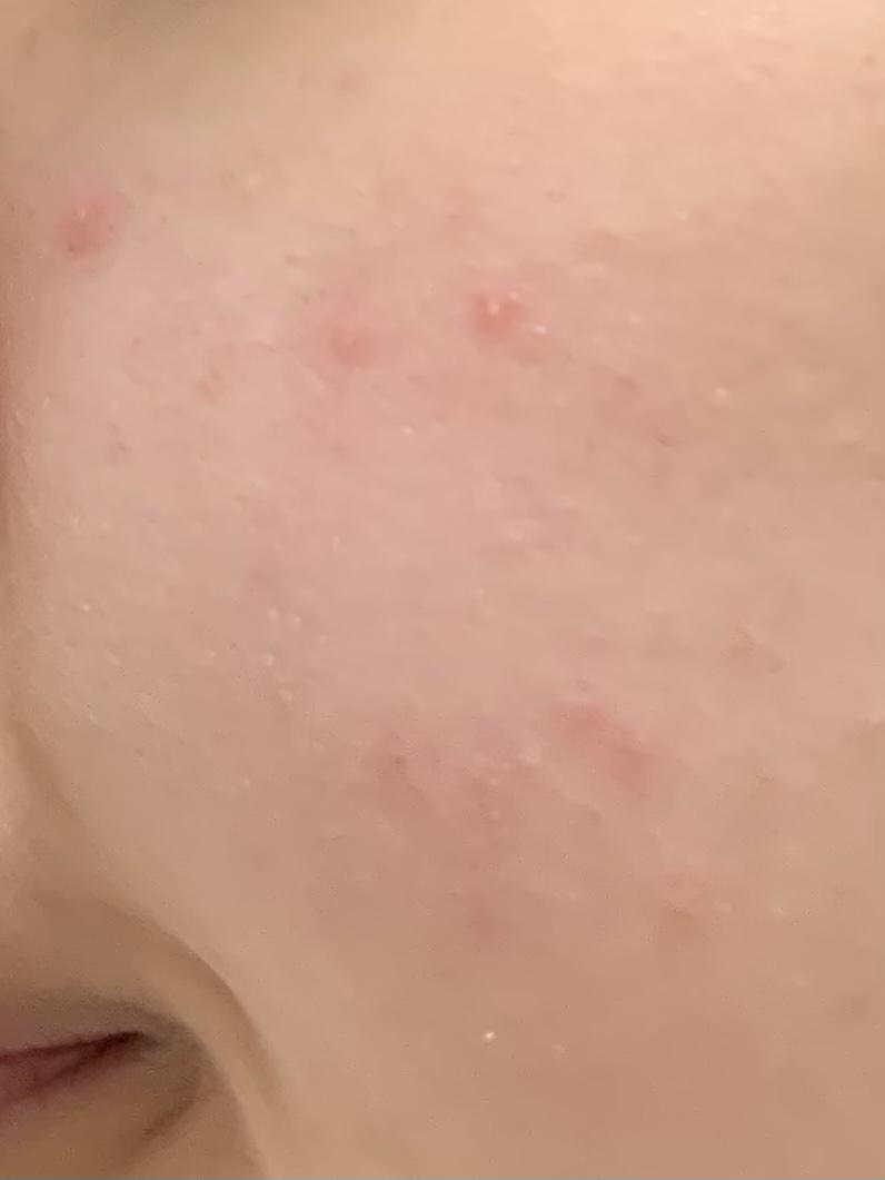 피부과 갔더니 의사쌤이 염증이라고 연고주셔서 며칠 발랐더니 괜찮아졌었다가 야자시간에 저녁으로 기름진 음식? 좀 오랜만에 햄버거, 떡볶이, 라면