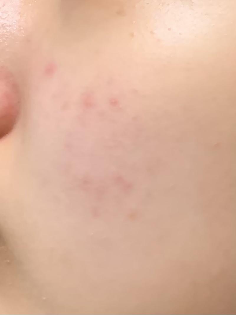 피부과 갔더니 의사쌤이 염증이라고 연고주셔서 며칠 발랐더니 괜찮아졌었다가 야자시간에 저녁으로 기름진 음식? 좀 오랜만에 햄버거, 떡볶이, 라면