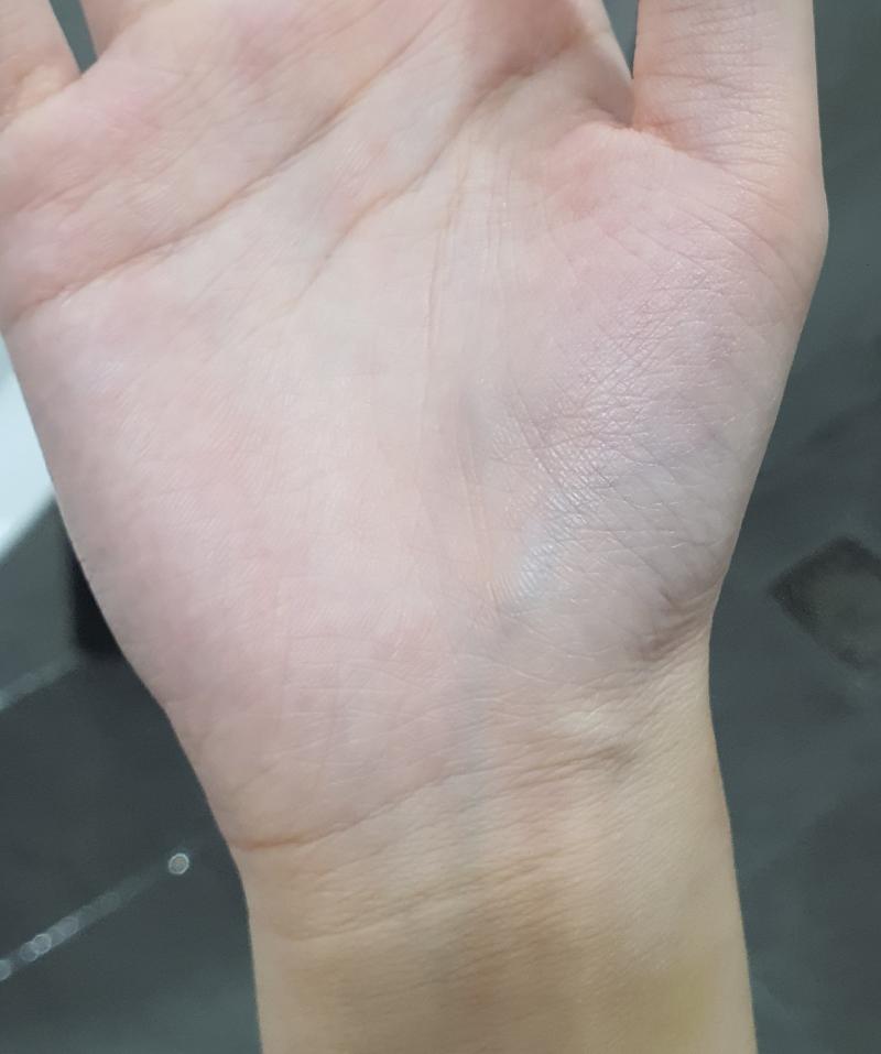 손등도 아닌 손바닥에 혈관 잘 보일 수도 있음? 그리고 드문드문 볼록 튀어나와있는데 이거 괜찮은거냐.. 가끔씩 손에 힘도 없고 손바닥에 혈관 잘