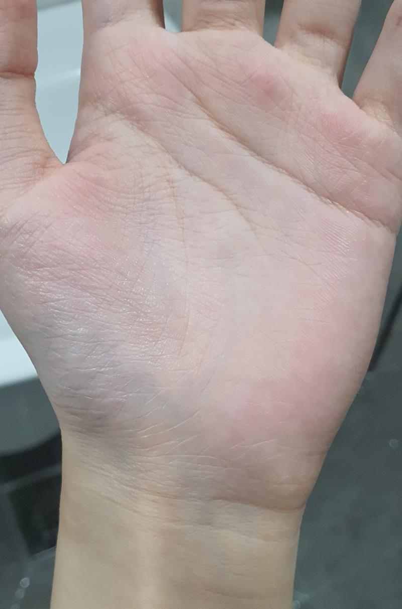 손등도 아닌 손바닥에 혈관 잘 보일 수도 있음? 그리고 드문드문 볼록 튀어나와있는데 이거 괜찮은거냐.. 가끔씩 손에 힘도 없고 손바닥에 혈관 잘
