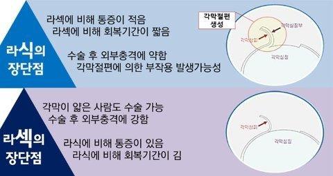 건강) 라식과 라섹의 장단점