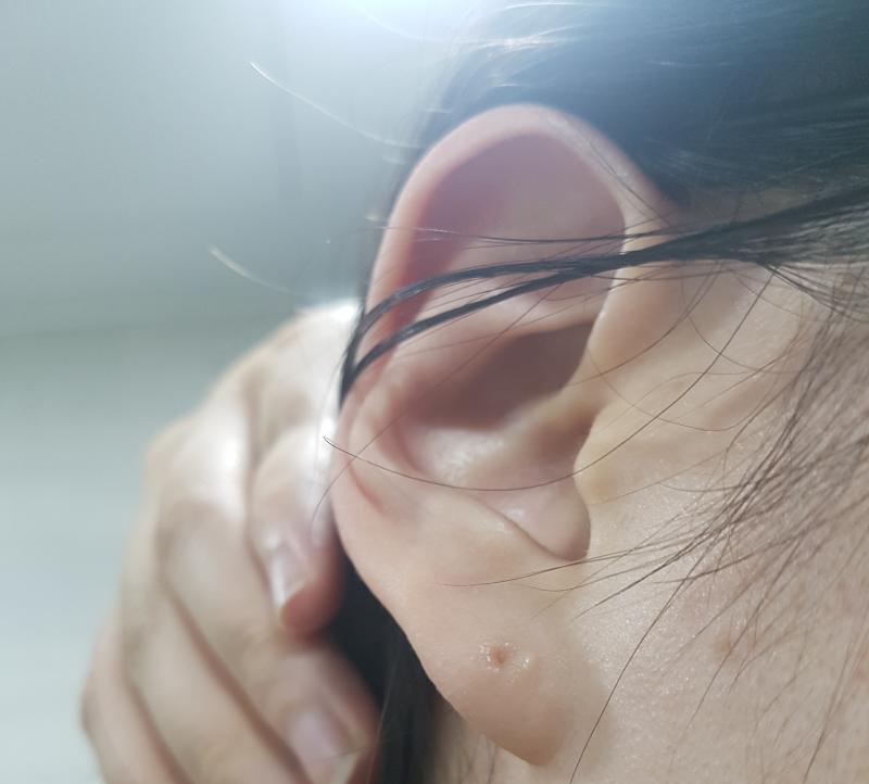 내 원래 귓볼이 얇은 편이라 많이 티가 안 날수도 있는데 엄청 부었어ㅠㅠㅠㅠㅠ 정상일 때랑 비교할 수 있도록 반대쪽 사진도 올릴게! 저것도 살튀