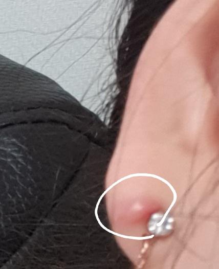 어어어어 저거 저대로 두면 가라안ㄱ긴할텐데 저거 나중에 아마 이렇게 몽우리 져서 남을거야 안없어질텐데... 난 귀걸이 빼고 막았어 딱히 병원은