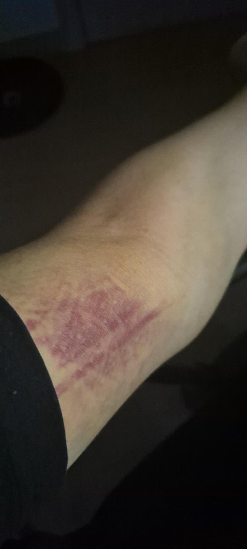 헌혈한지 좀 지난거 같은데 아직도 피멍이 안 빠진다 머지