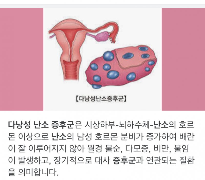 다낭성난소증후군 같음 몸에 큰 증상은 없고 임신 하기 어렵다고 하더라 이것도 체질이라 약물이나 수술은 어렵다고 들음 생각보다 주변에 다낭성난소증