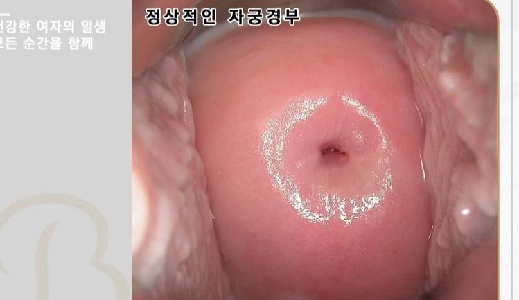 >>32 정상적인 자궁걍부 사진이야 옆에 오돌토돌한건 질벽이구 우린 매끈한 막창처럼 생겻다고 표현하기도해 가운데 살짝 손톱이 걸리는 느낌? 왜에