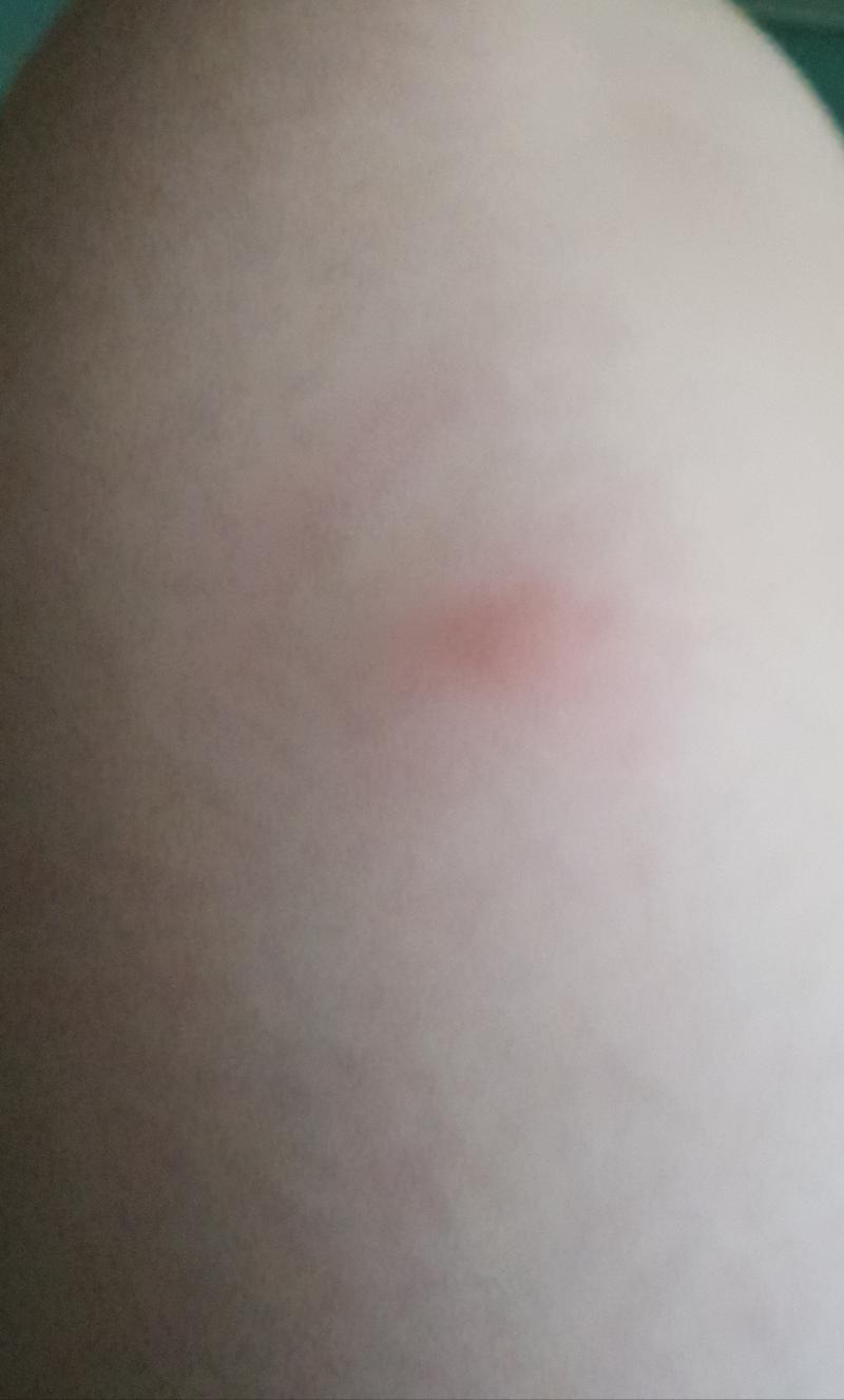 심하게 부었는데... 괜찮은 건가