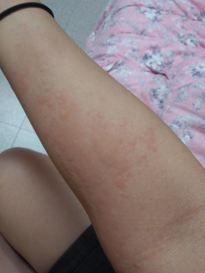 >>17 근데 진짜 가렵기만 하고 인터넷 에서 나온 응급실 갈 정도까진 아니라서... 그리고 나 지금 데이터 다 닳아가서 나중에 스레드 못 받을