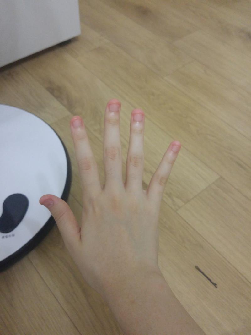 왼손 오른손 사진임 혐오스러울 수도 있으니까 주의!