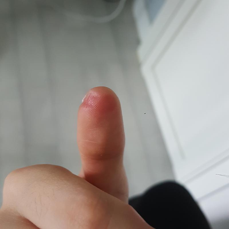존나자국이안없어짐
