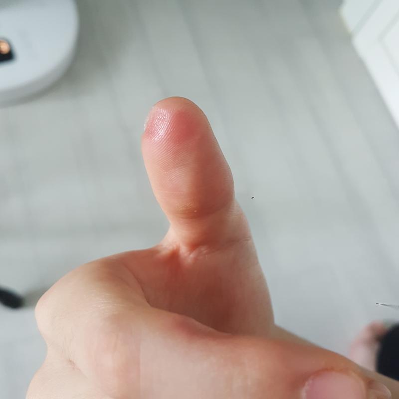 존나자국이안없어짐