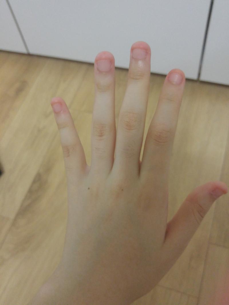 왼손 오른손 사진임 혐오스러울 수도 있으니까 주의!