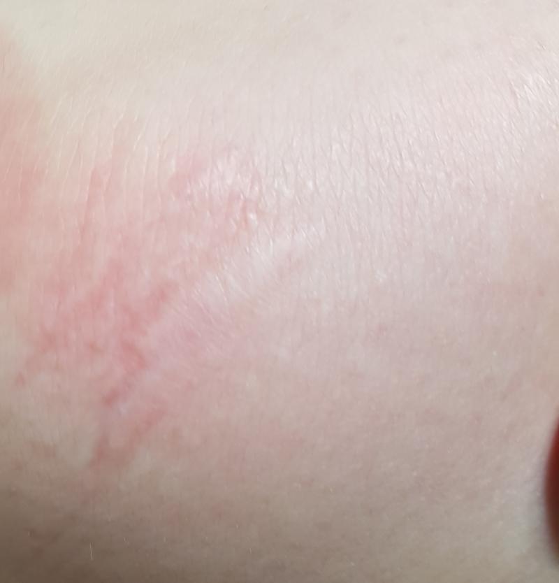 혹시모르니 다리 꼬맨 사진을...... 안보는거 추천 사실 뭐 징그럽진 않음.. 빨간건..내가 지금 무릎꿇고 있었어섴ㅎㅎㅋㅎㅋㅎㅋㅎ