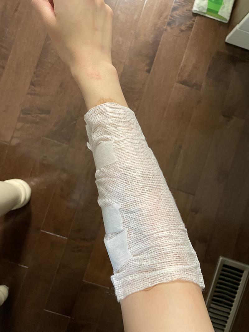 상처 사진은 못 찍었는데 대충 팔이 앞뒤로 난리가 나서 저렇게 감아놓음 ㅋㅋㅋㅋㅋㅋ 밴드로 감당이 안 되더랔ㅋㅋㅋㅋㅋㅋㅋ
