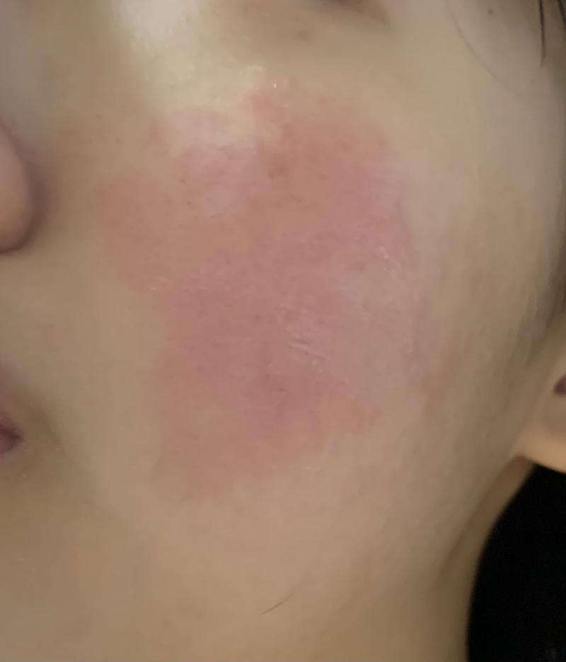 저 붉은 부분은 살짝 올록볼록까진 아닌데 좀 나와있음 피부결이 걍 주변이랑 달라