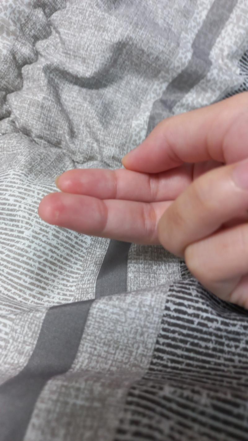 >>303 물질 껍질이 다시 손가락에 붙었어! 미묘하게 어둡고 반질반질 빛나는 피부가 물집이었던 피부양