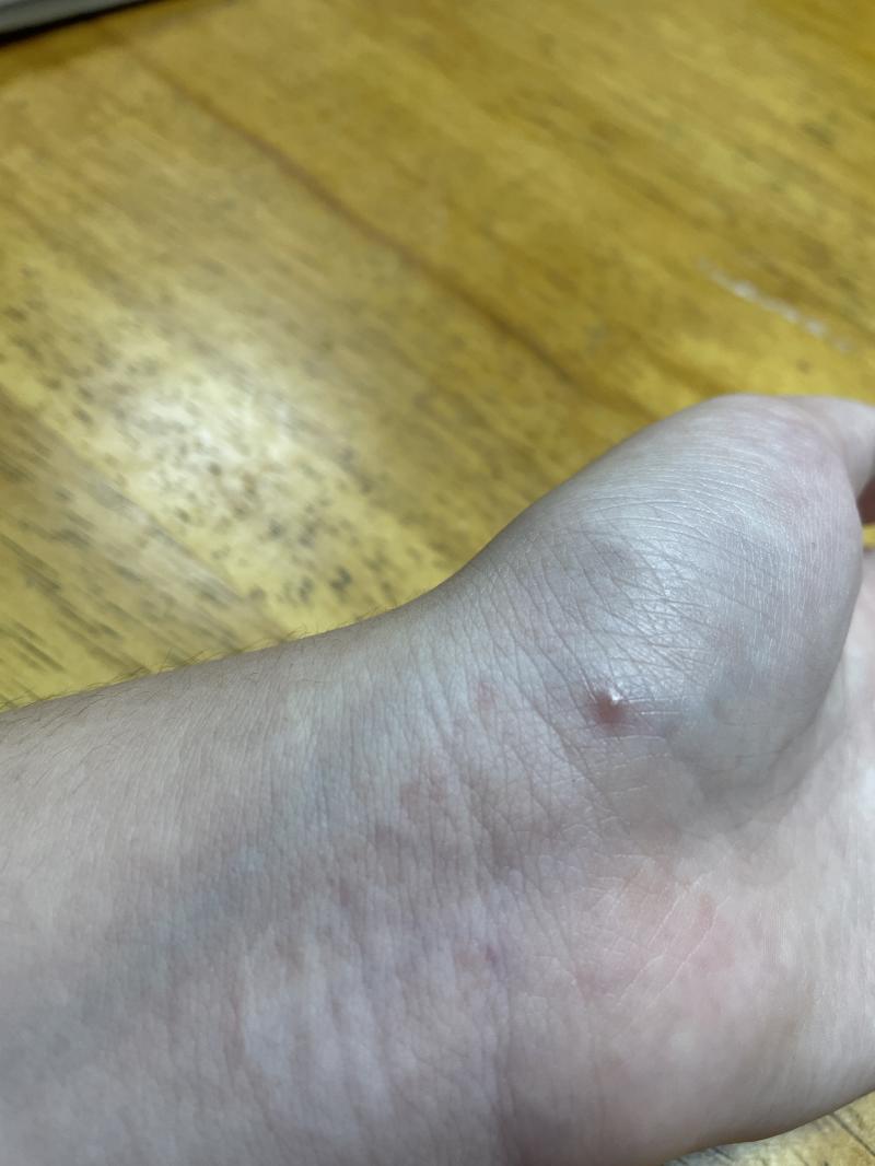 사진 첨부할게 그렇게 징그러운 사진은 아닌데 물집 같은 거 잘 못 본다 그러면 넘겨!!!