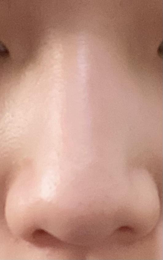 살 10kg정도 빼면 콧볼 작아질 수 있을까ㅠ? 콧볼 보톡스…? 이런 것도 있던데 혹시 해본 사람…
