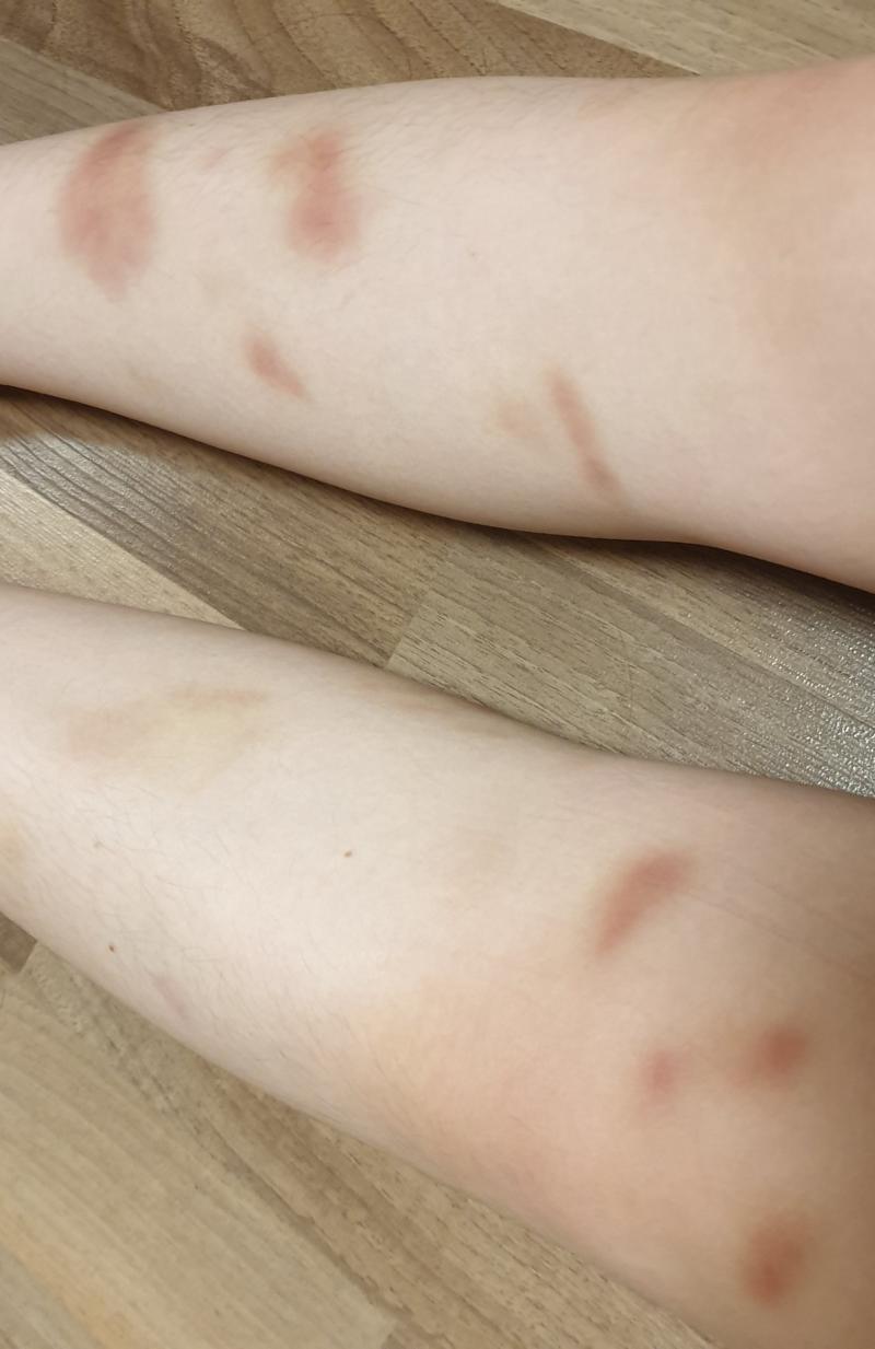 혹시 멍 사진 그런거 못보면 안보는걸 추천... 내 친구들 다 충격 먹음.