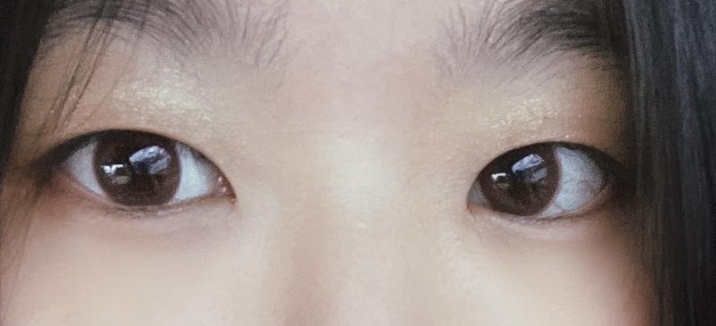 >>4 쌍꺼풀 두께라면 나도 >>5와 이하동문. 그건 쌍수해야되. 나도 속쌍 두껍게 있는 편이라 쌍수 비절개로 했고 지금은 6주차! 쌍수 말고도