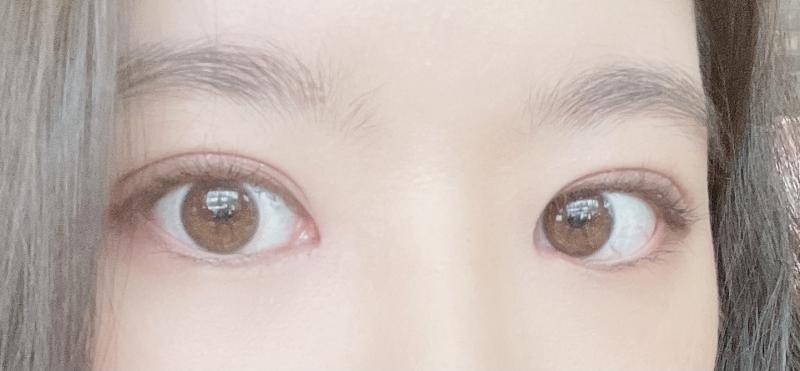 >>4 쌍꺼풀 두께라면 나도 >>5와 이하동문. 그건 쌍수해야되. 나도 속쌍 두껍게 있는 편이라 쌍수 비절개로 했고 지금은 6주차! 쌍수 말고도