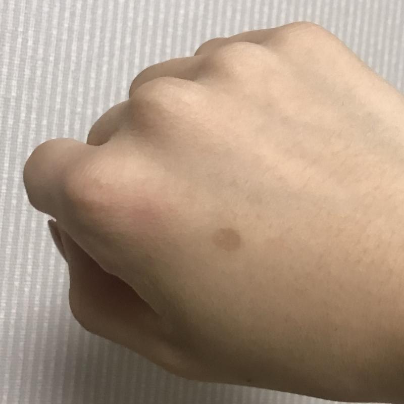 너무 보기 흉하지않아??ㅜㅜ 연고 바르면 정말로 사라지려나..