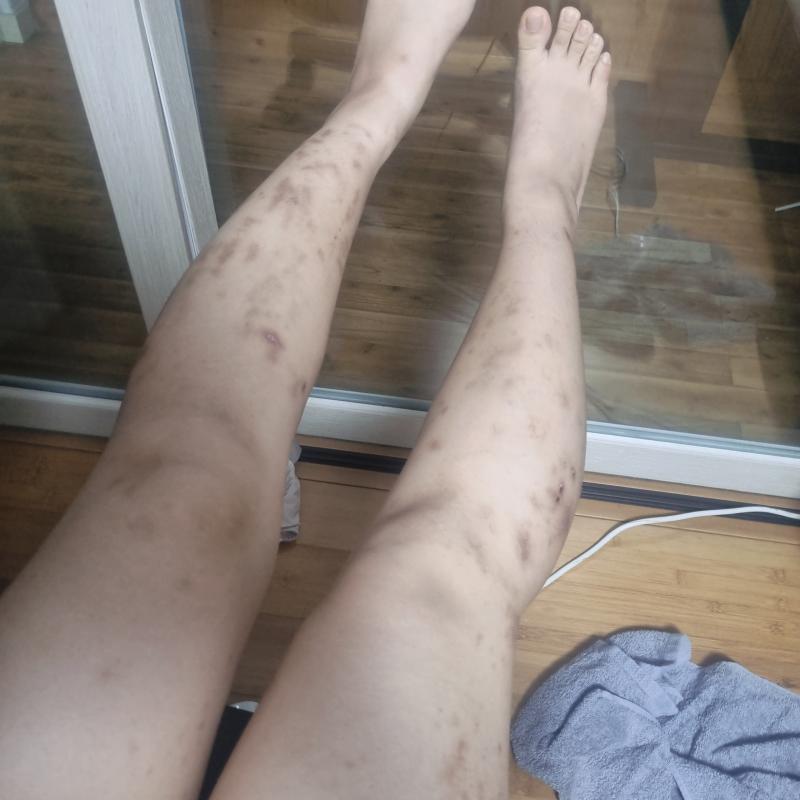 다리사진 * 혐오주의 * 흉터연고는 동*제약 스*논 발라볼거야.
