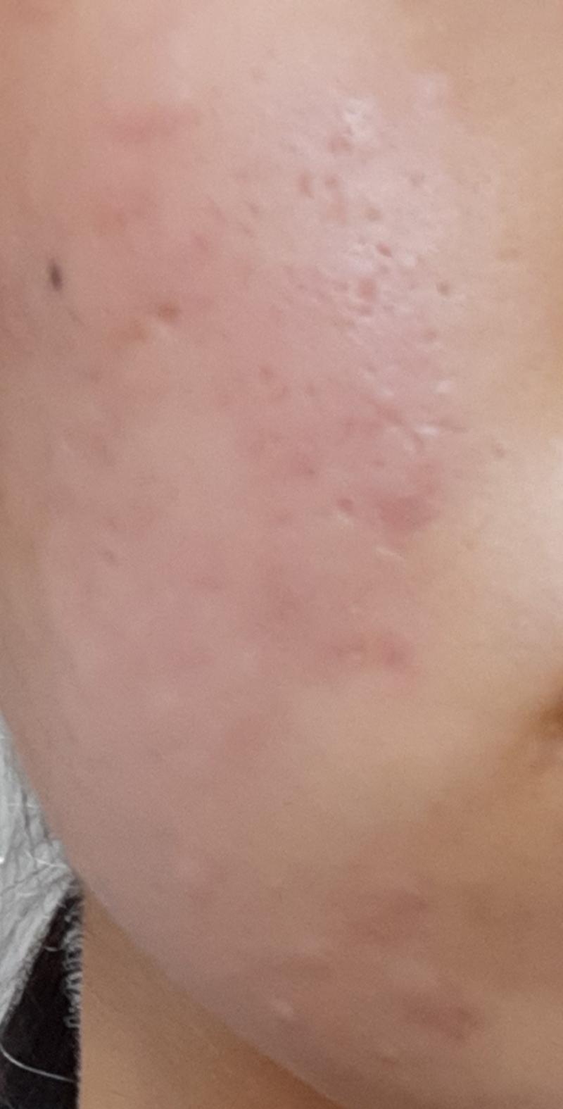 사진을 잘 못찍어서;;저건 오른쪽 볼이고 왼쪽볼도 그래 딱 눈아래까지 저런데 뭔지 아는사람ㅠㅠ
