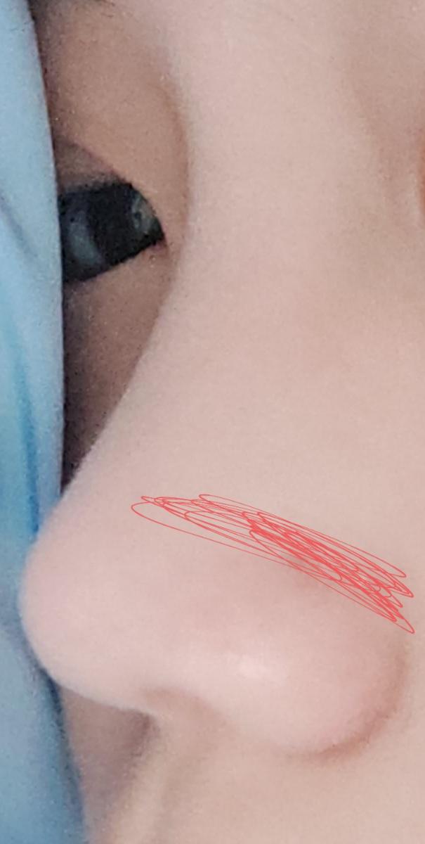 나 고딩되면진짜 바로 코수술ㅇ하고싶다 레더들은 코예뻐서 부럽다