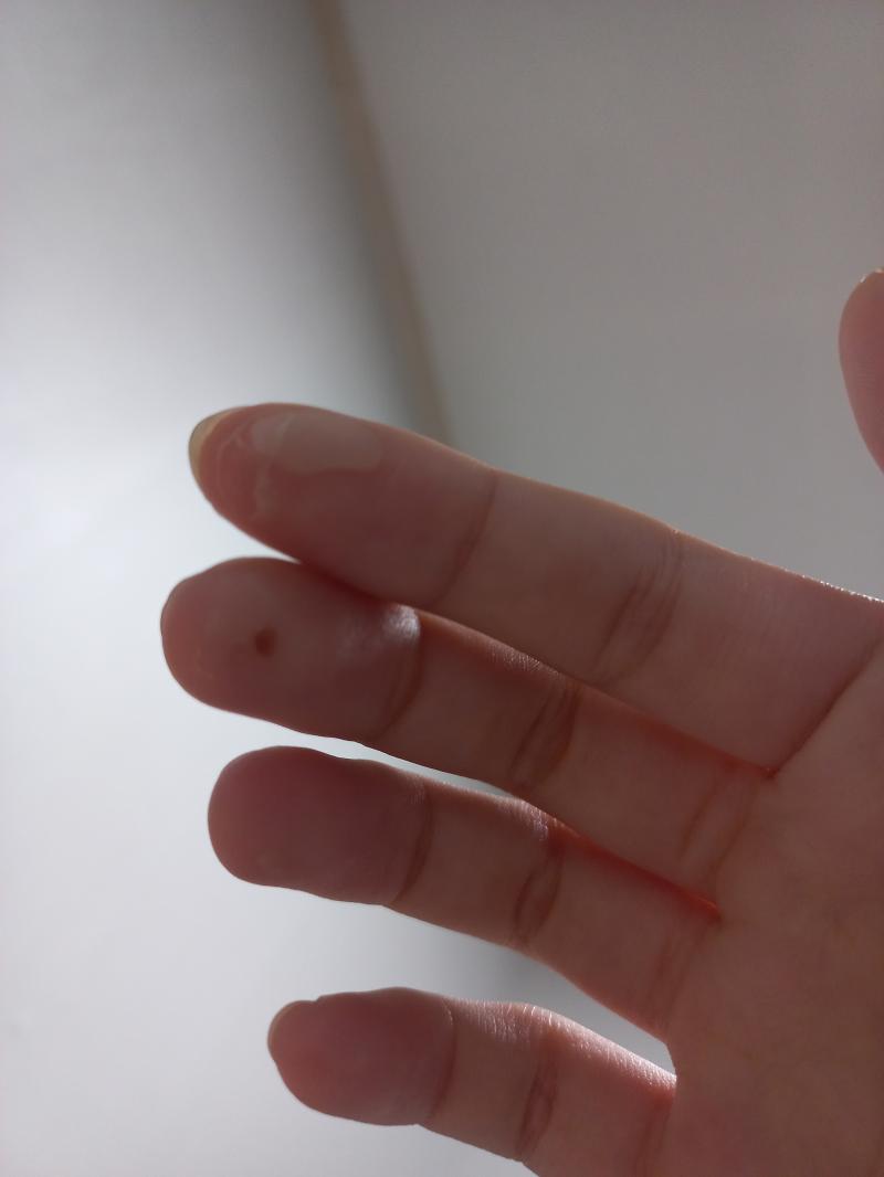 징그럼!!!!! 물집얘는언제붙냐 일주일됐다 일주일;;;; 징하다 징해