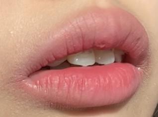 교정중이라 입술 전나 못생김 ㅈㅅ
