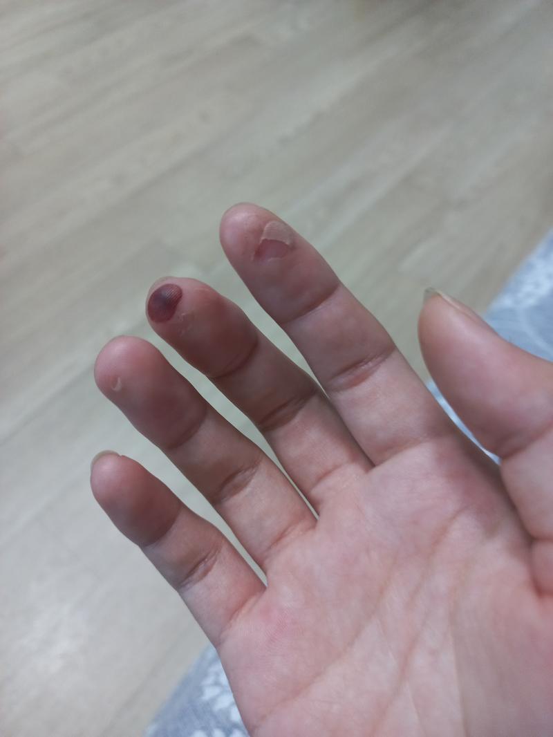 혐오 주의 가야금해서 잡힌 물집 아프지는 않은데 비주얼은 굉장히 아파보임... 밴드로 칭칭 싸고 가야겠다